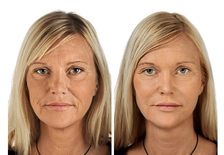 restylane before and after